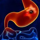 thumb-pepticki-ulkus