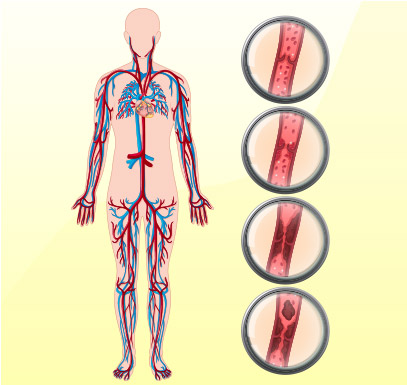 Duboka venska tromboza - Kolegium Medic